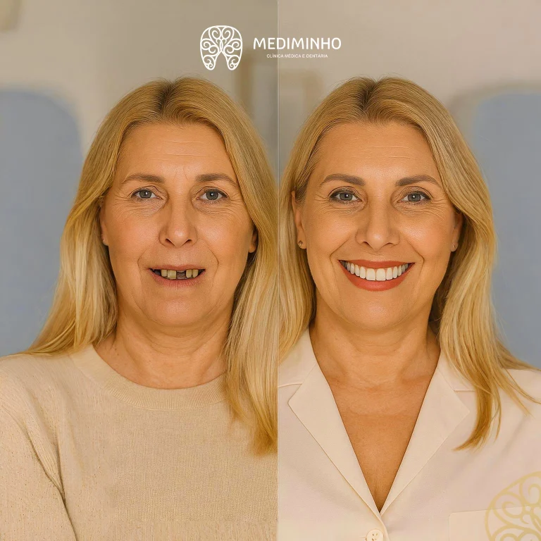 antes-depois-regeneracao-ossea-implantes-mediminho-braga