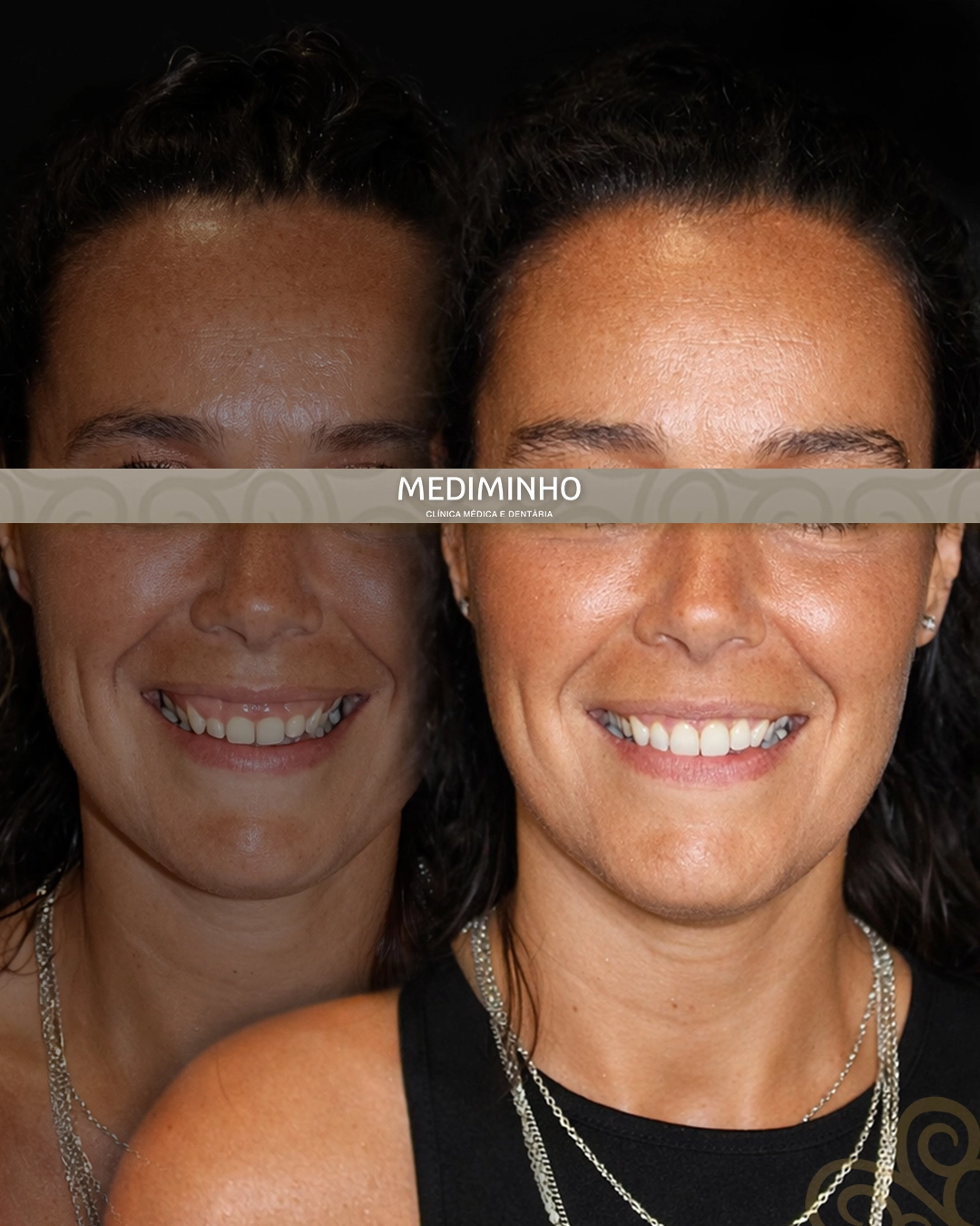 Caso clínico de periodontologia com correção de sorriso gengival através de alongamento de coroa clínica realizado na Mediminho, em Braga