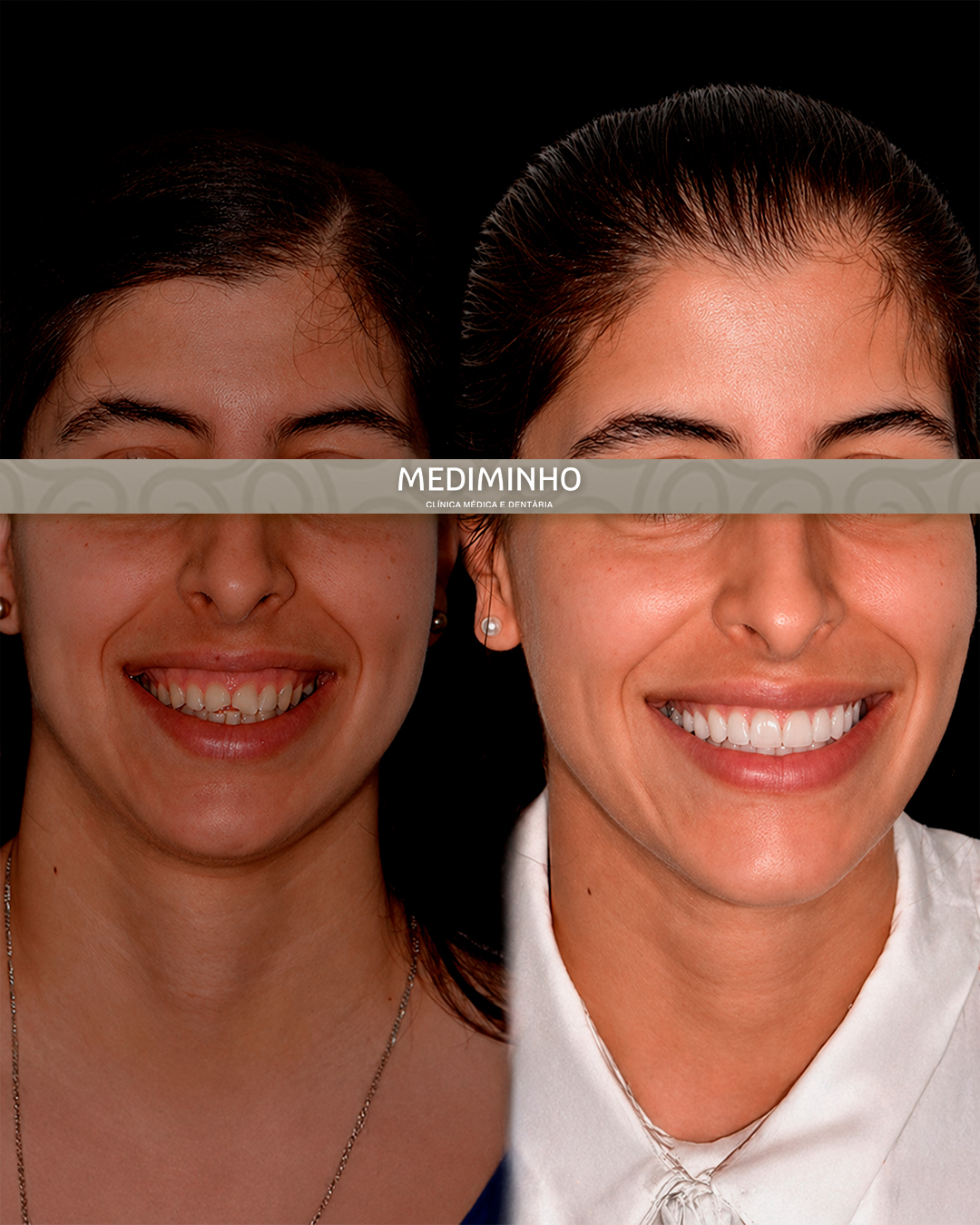 Antes e depois de reabilitação estética com facetas cerâmicas para harmonização e naturalidade do sorriso realizada em Braga