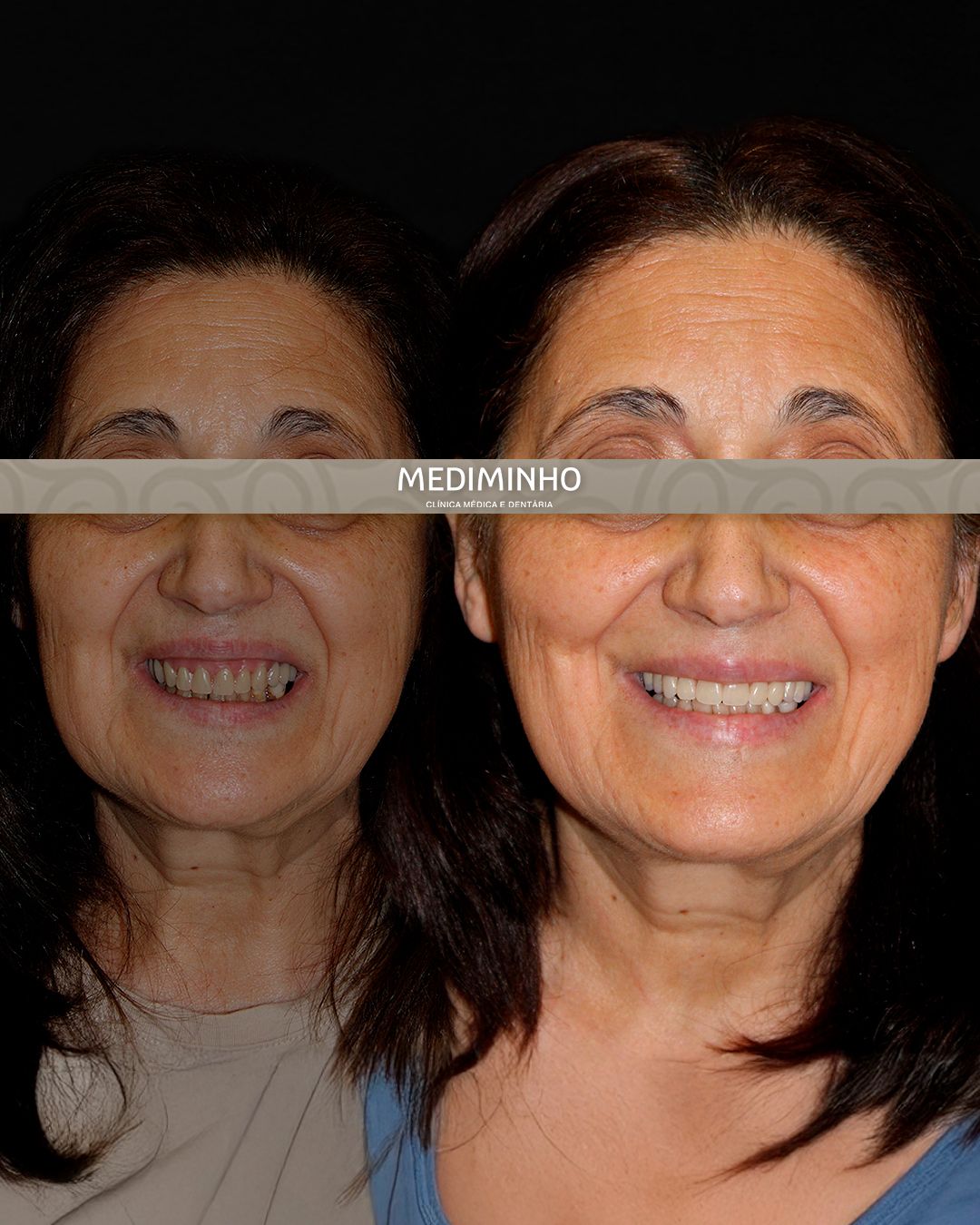 Antes e depois de reabilitação total superior para recuperação estética e funcional do sorriso realizada na Mediminho em Braga