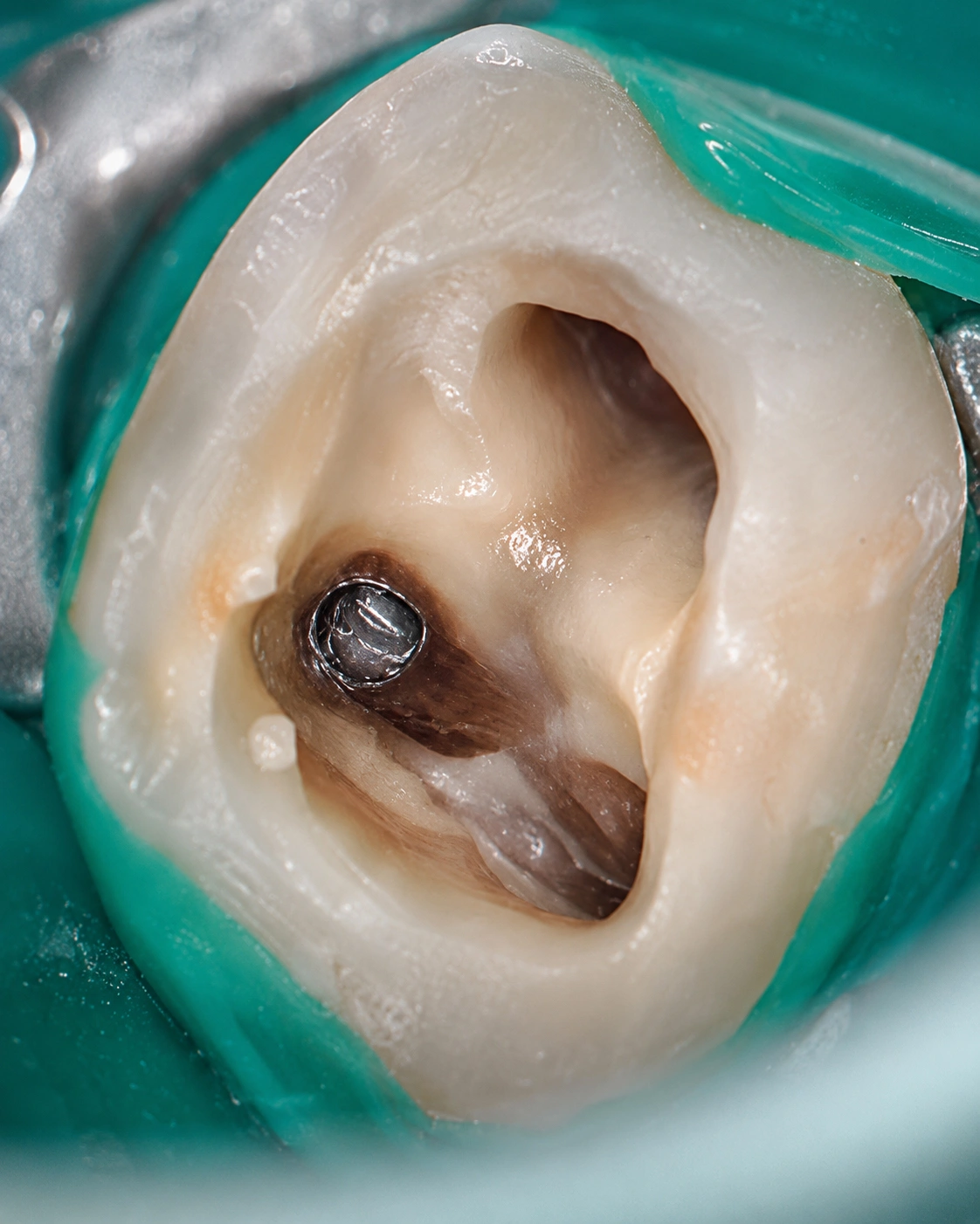 Procedimento endodôntico de remoção de uma lima fraturada no interior de um dente com auxílio de microscópio clínico.