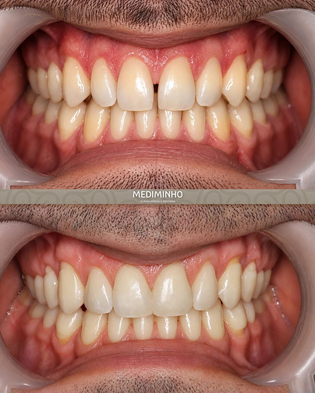 Antes e depois de restaurações estéticas para fecho de diastemas, realizadas na Clínica Mediminho em Braga, com harmonização natural do sorriso.