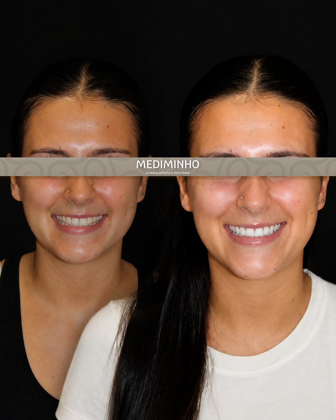 Antes e depois de branqueamento dentário ambulatório com acompanhamento clínico na Mediminho, em Braga
