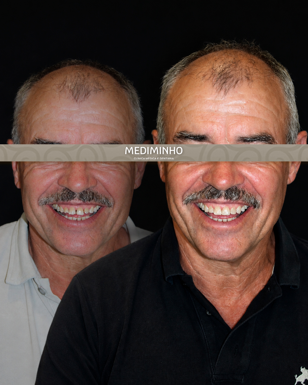 Antes e depois do fecho de diastemas com facetas em resina composta na Mediminho, em Braga