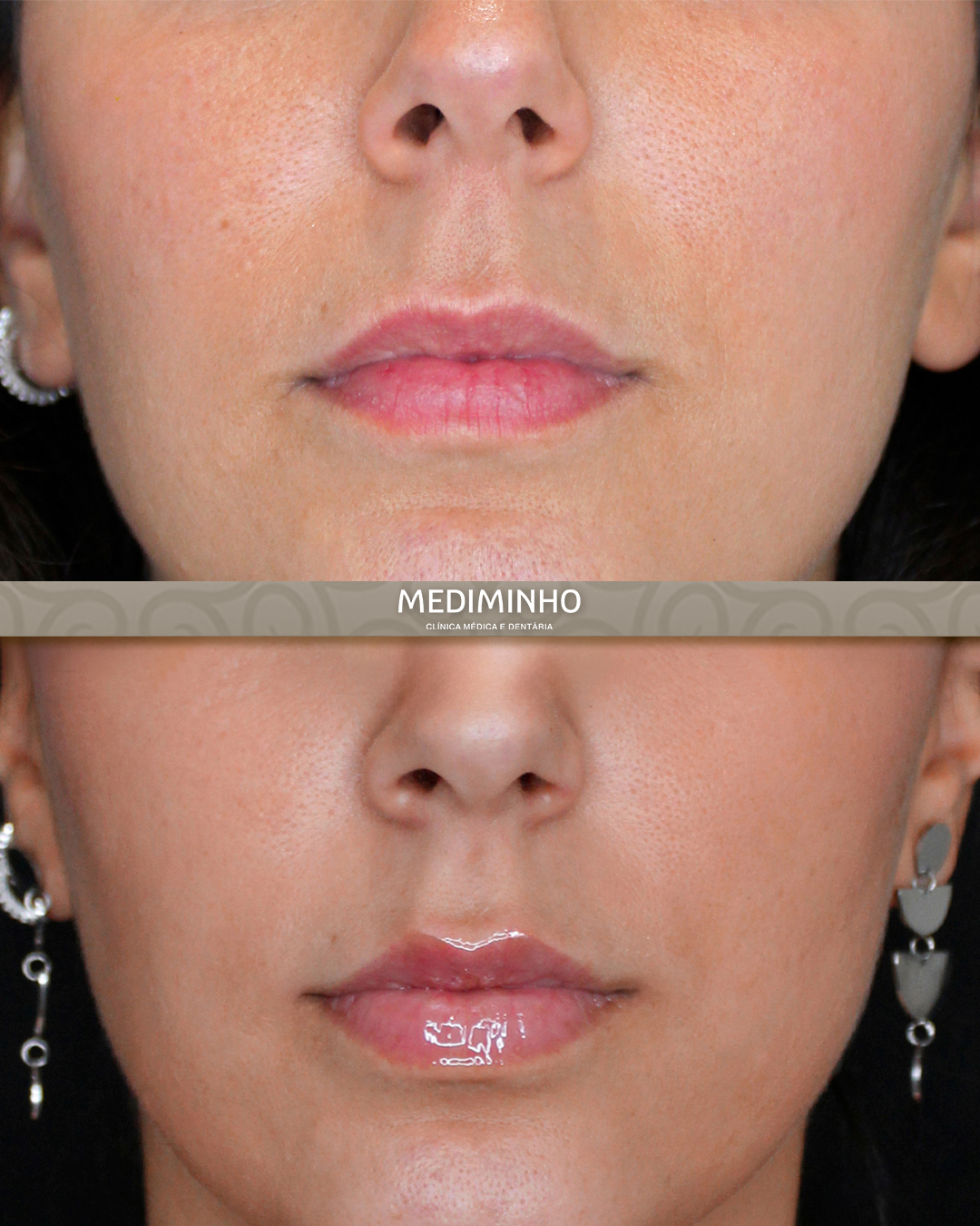 Antes e depois de preenchimento labial com ácido hialurónico em vista frontal na Mediminho, em Braga