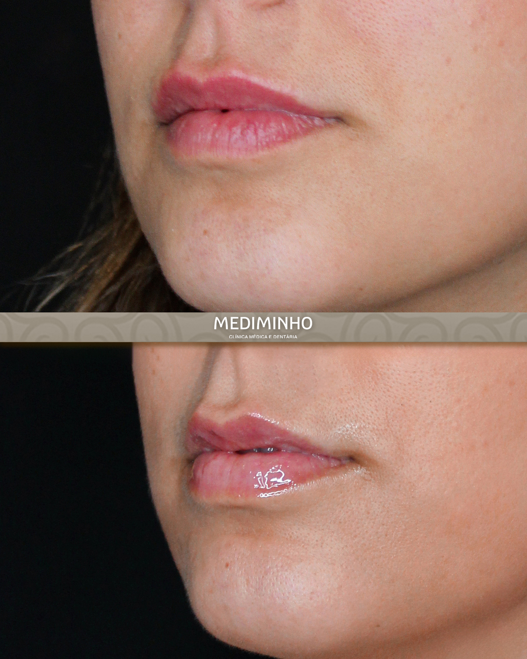 Antes e depois de preenchimento labial com ácido hialurónico em vista lateral na Mediminho, em Braga