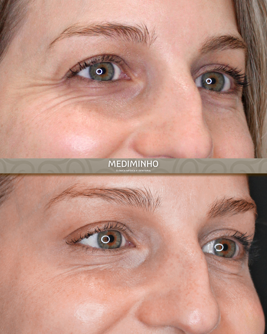 Antes e depois de tratamento com toxina botulínica para suavização de linhas de expressão na região dos olhos, na Mediminho em Braga