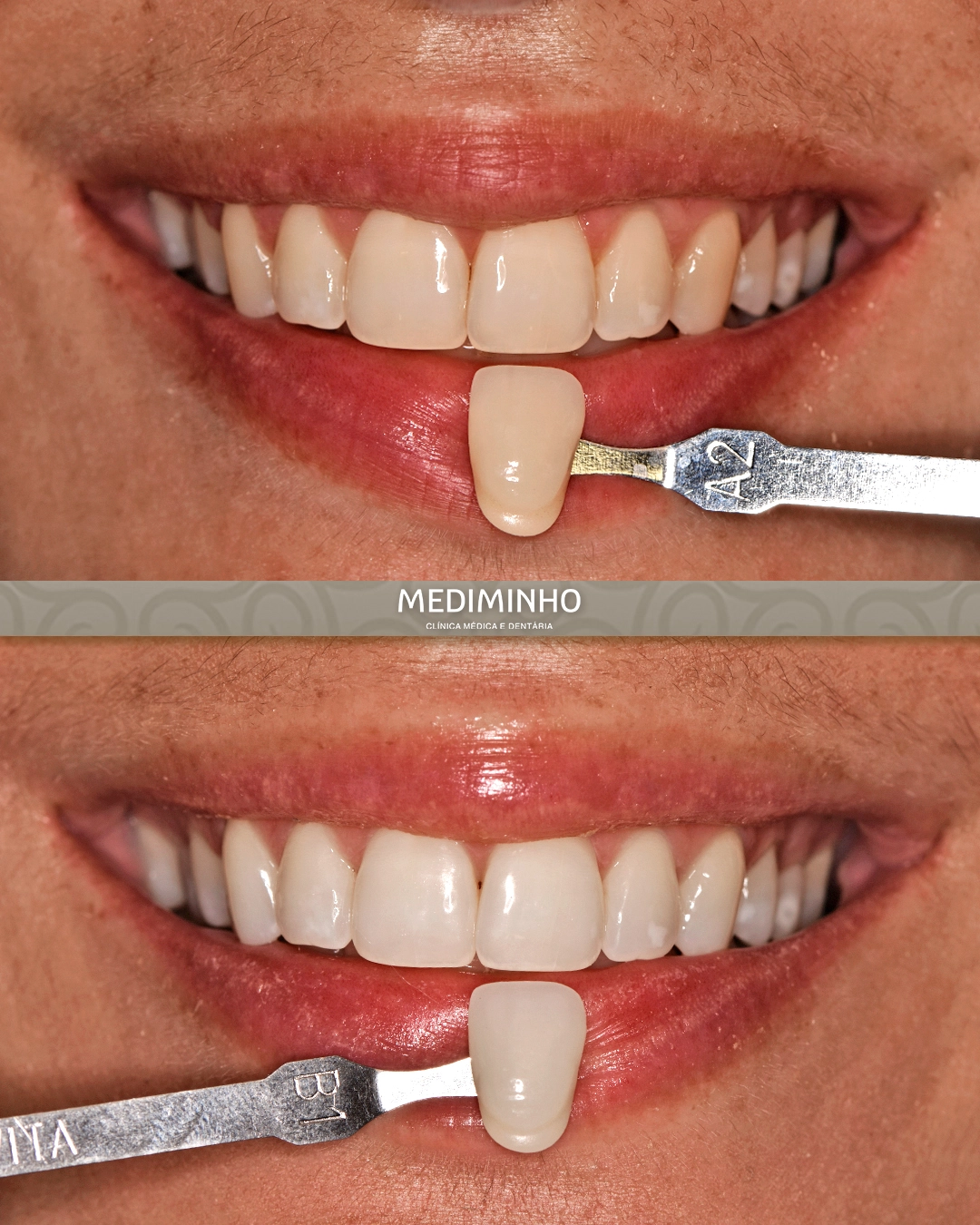 Antes e depois de branqueamento dentário ambulatório com comparação de cor através de escala dentária na Mediminho, em Braga