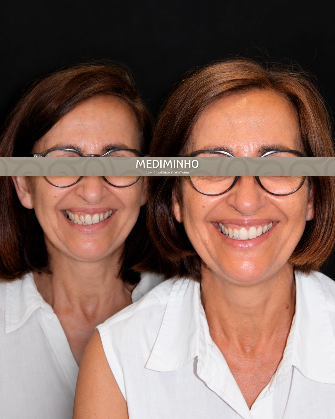 Antes e depois de reabilitação oral com facetas em resina composta e reabilitação fixa sobre implantes na Mediminho, em Braga