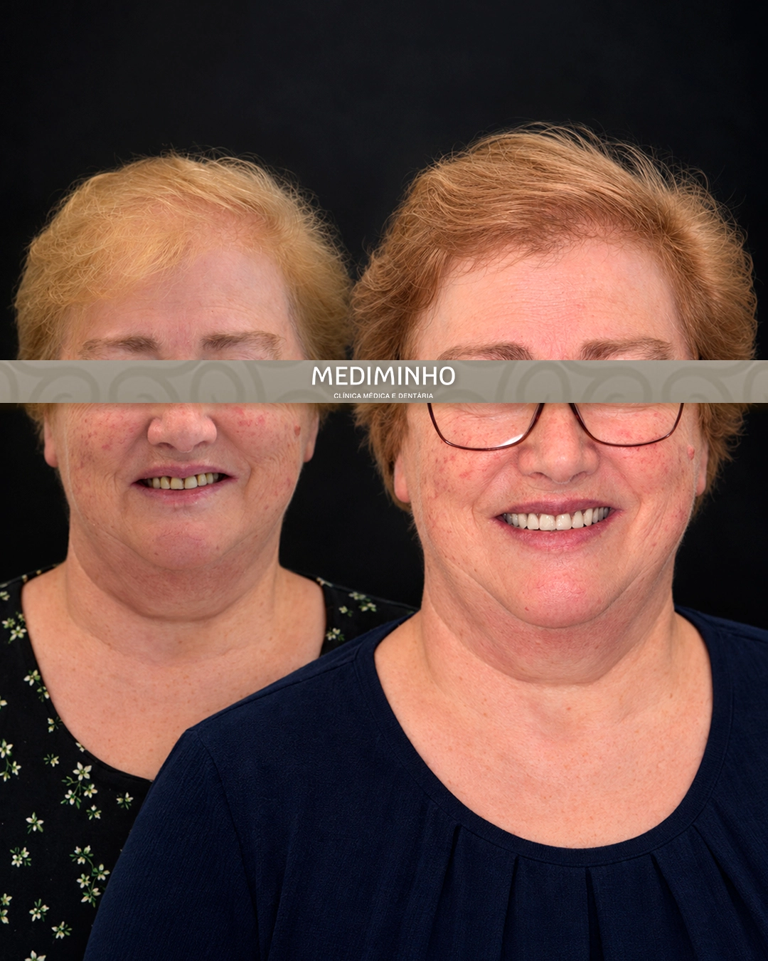 Antes e depois de reformulação de reabilitação oral superior para melhoria da estética, função e harmonia do sorriso na Mediminho, em Braga