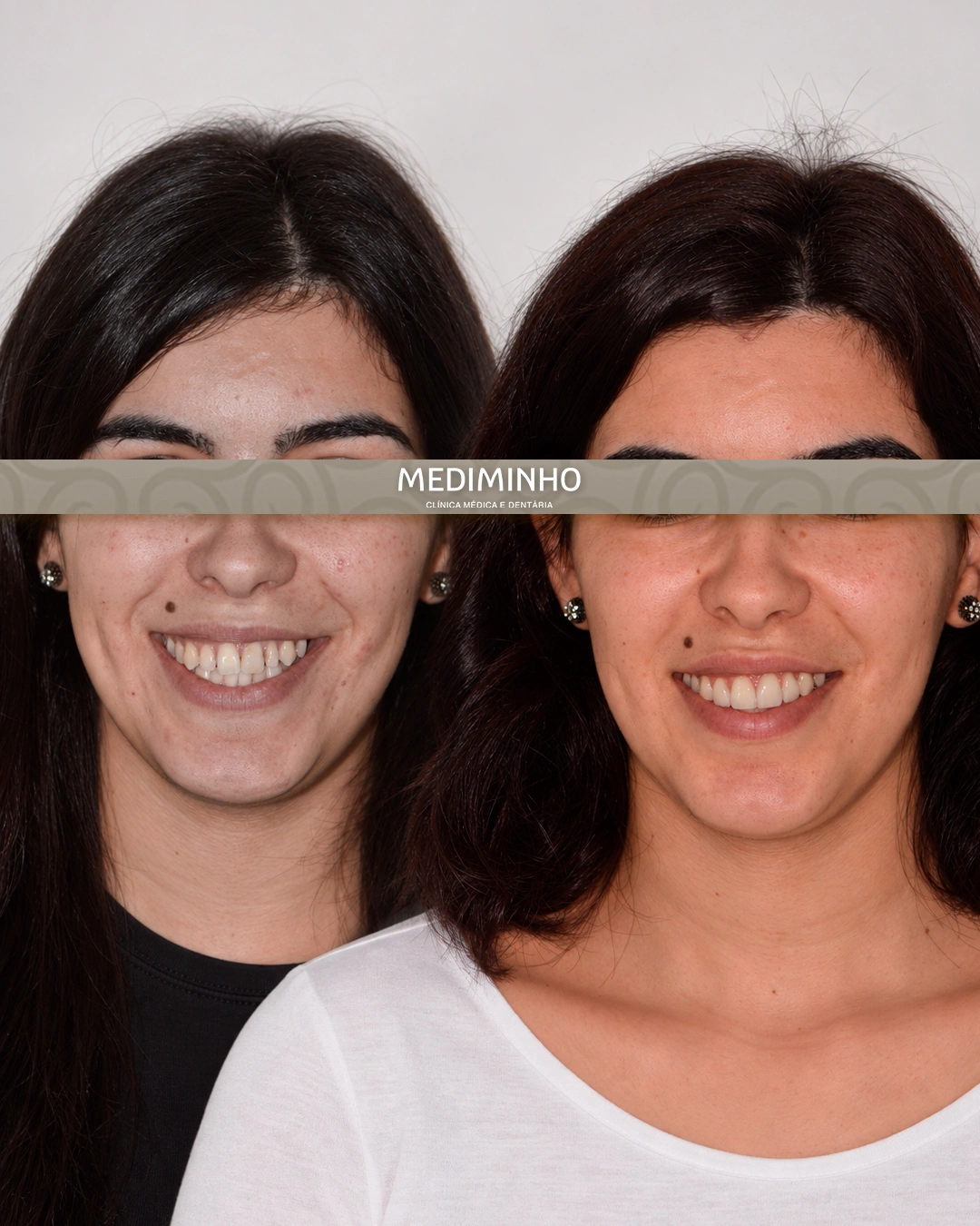 Antes e depois de branqueamento dentário e reabilitação fixa dos dentes anteriores superiores em Braga